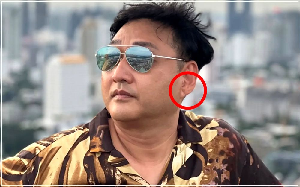 김수용 귓볼 사선 주름 프랭크 징후 전조증상 있었다?