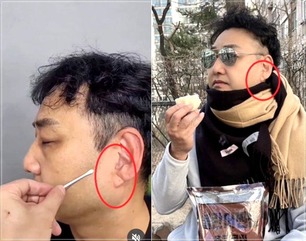 김수용 귓볼 사선 주름 프랭크 징후 전조증상 있었다?